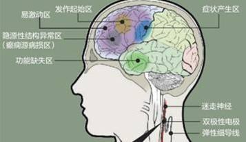 婴儿癫痫|婴儿癫痫之Lennox-Gastaut综合征