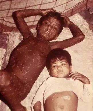 疫苗|到底是谁发明了疫苗？中国人有功么？