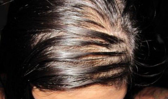 方法消除头螨,头上有螨虫的几个症状