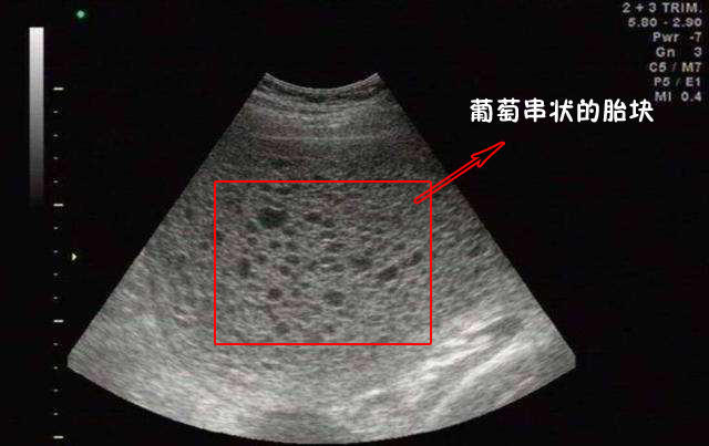 早孕反應要當心出現這5種反應多半是葡萄胎找上門