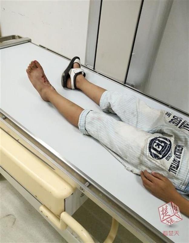 7岁男童坐共享单车车篮脚被卷入车轮血肉模糊