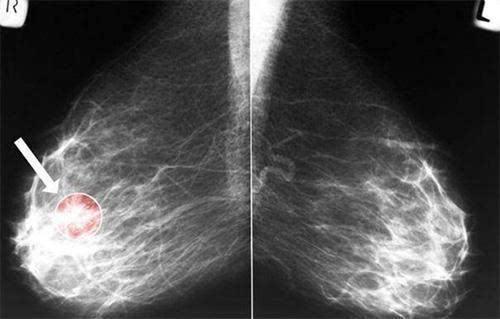 乳腺肿块就是乳腺癌吗?如何区分良恶性肿块,看