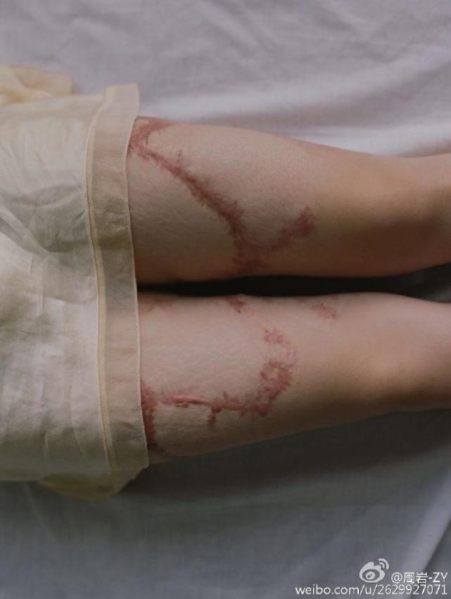 她曾被富二代泼硫酸现勇敢拍写真