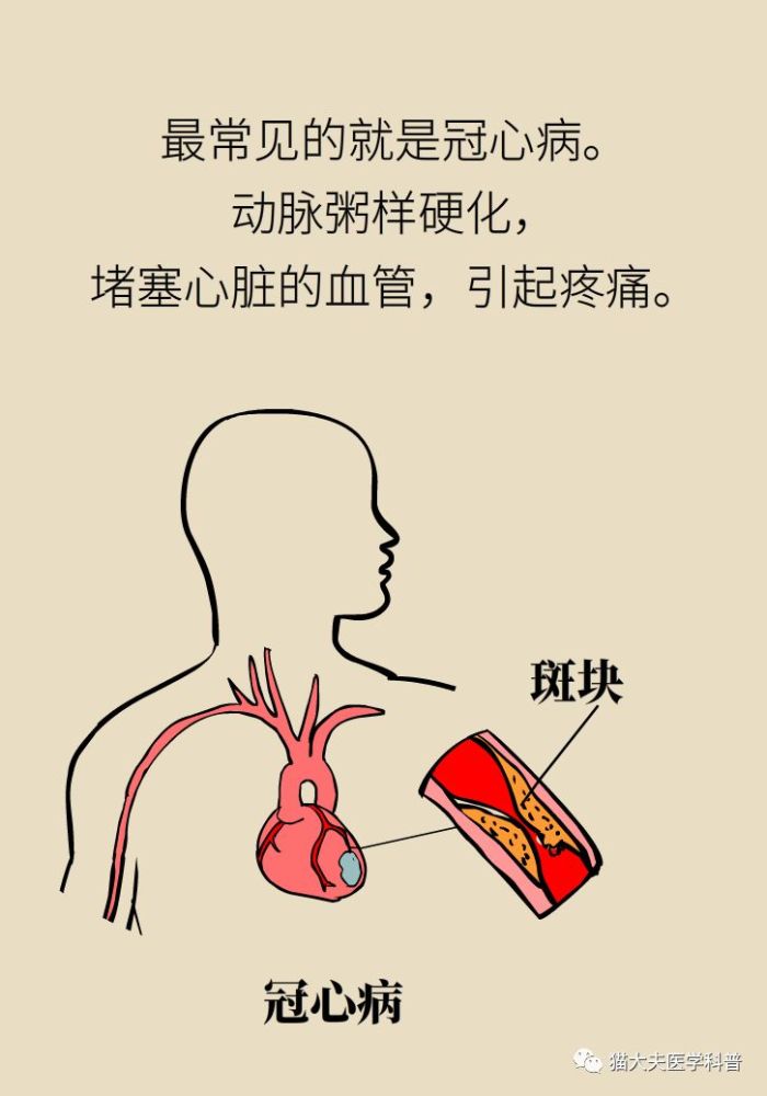 胸痛|胸痛不一定是心梗，这10大原因要记牢！