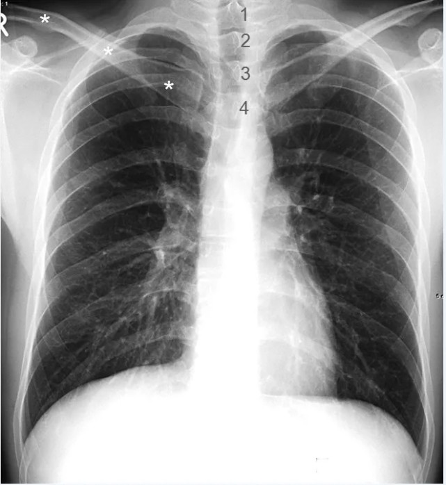 影像解剖入门正常胸片怎么看