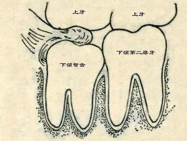 智齿到底要不要拔?你想知道的都在这!