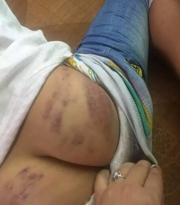 8岁男孩背不出古诗屁股被打得青紫