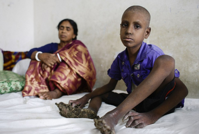 男孩患怪病变树人手脚长树皮