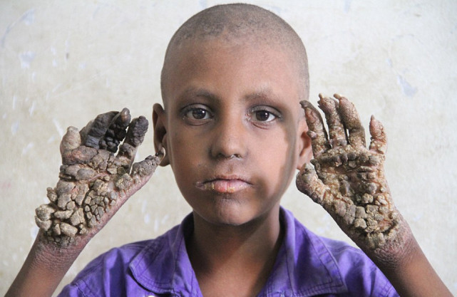 男孩患怪病变树人手脚长树皮