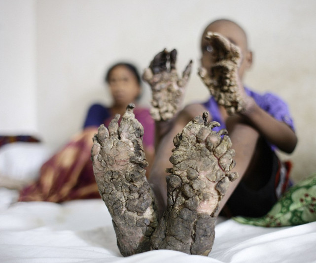 男孩患怪病变树人手脚长树皮