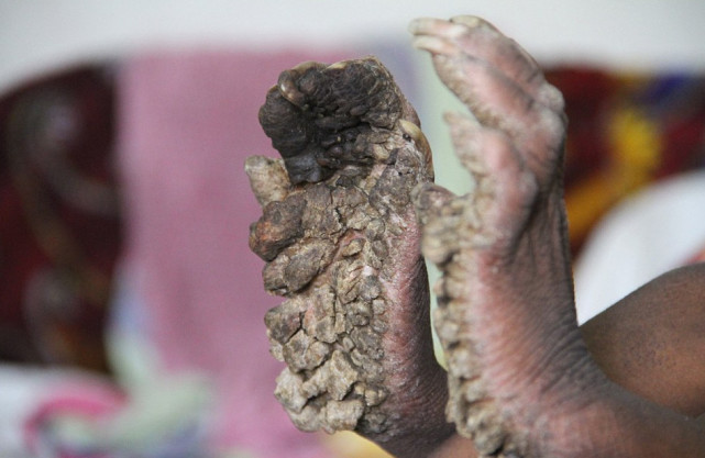 男孩患怪病变树人手脚长树皮