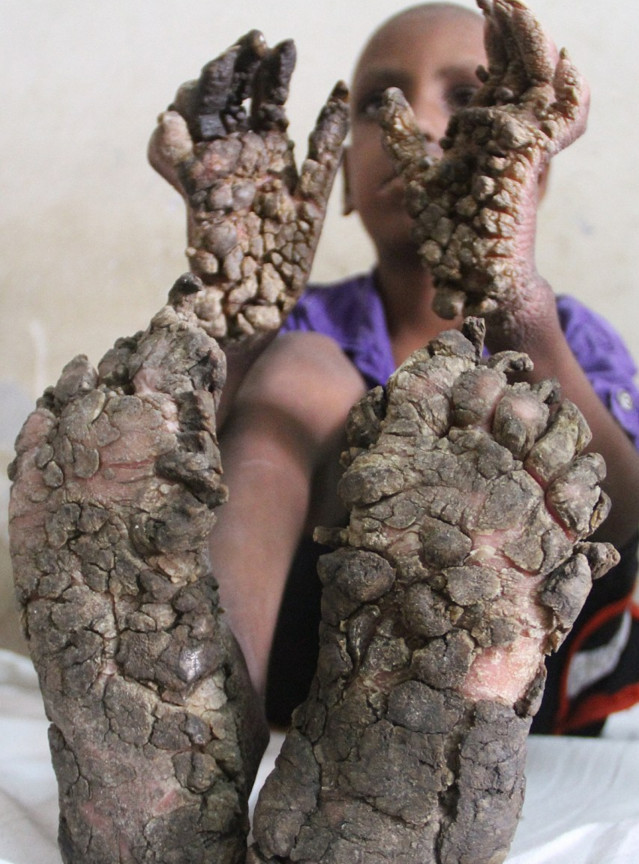 男孩患怪病变树人手脚长树皮