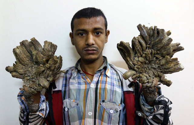 男孩患怪病变树人手脚长树皮