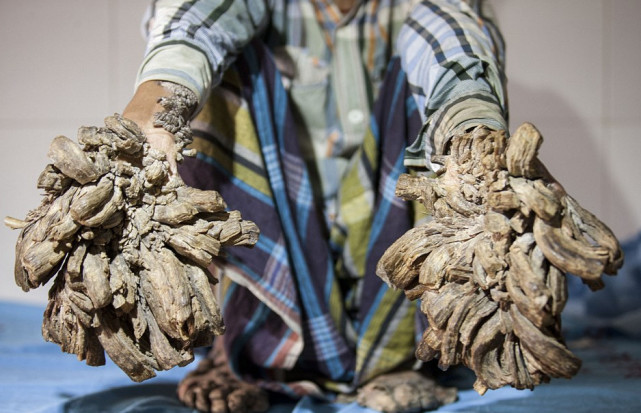 男孩患怪病变树人手脚长树皮
