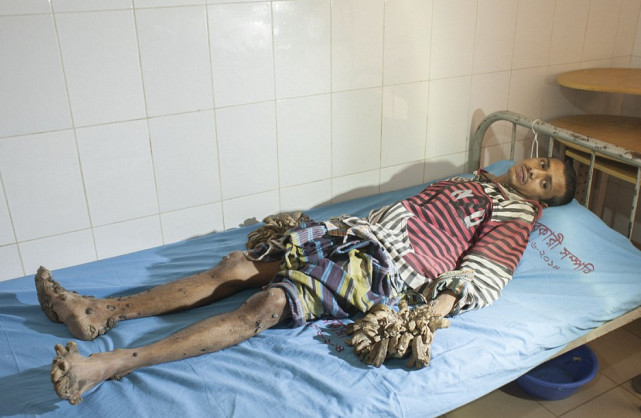 男孩患怪病变树人手脚长树皮