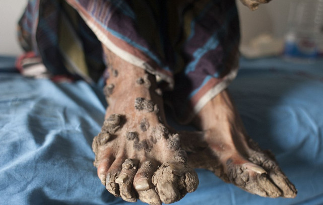 男孩患怪病变树人手脚长树皮