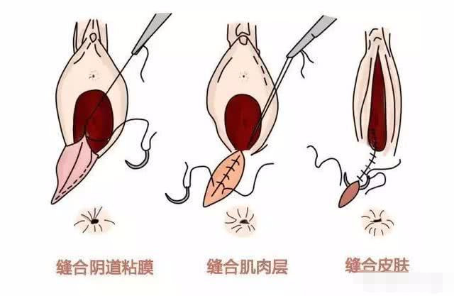顺产的宝妈是撕裂好,还是侧切好?疼不疼?