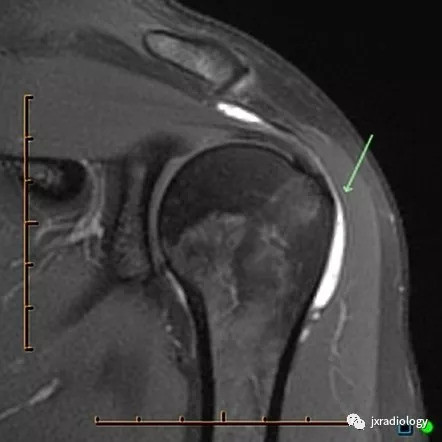 图1:肩峰下 - 三角肌下滑囊(subacromial-subdeltoid bursa)详解图片