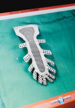 女子换上3d打印人造胸骨