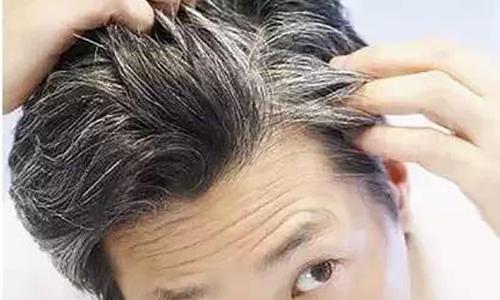 年轻人长白发的首要原因及应对方法