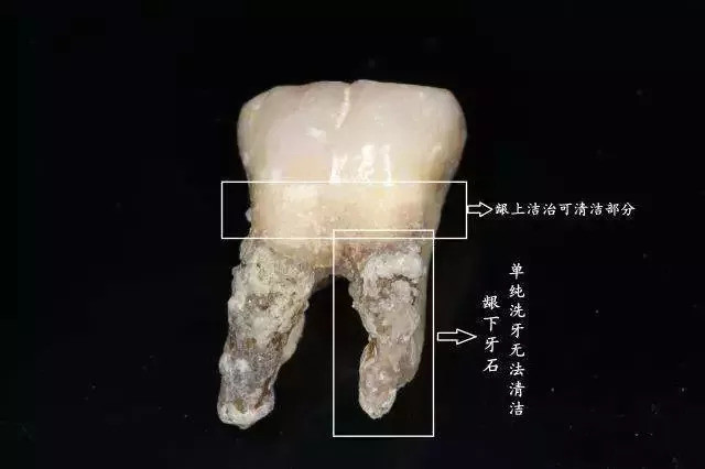 牙结石会导致牙齿松动吗?它能否自动脱落