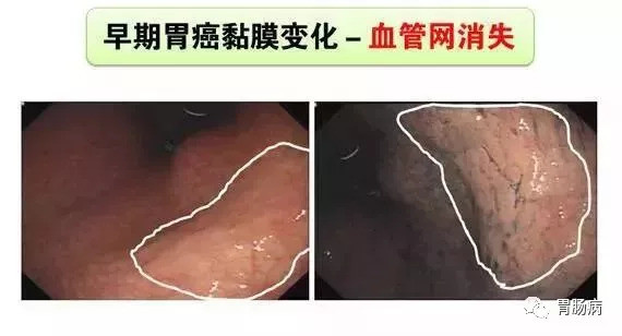 手把手教你利用胃镜发现早期胃癌