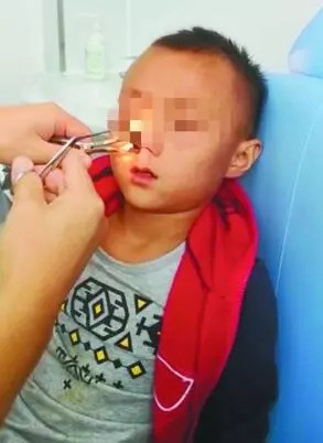 8岁男童频繁流鼻血医生取出蚂蟥 医生称可能与