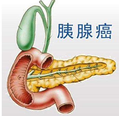 胰腺癌5年生存率低,如何早期發現胰腺癌,聽聽專家怎麼說!