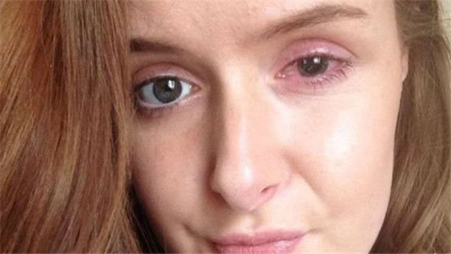 如果连续戴1年的隐形眼镜睡觉,后果到底有多严