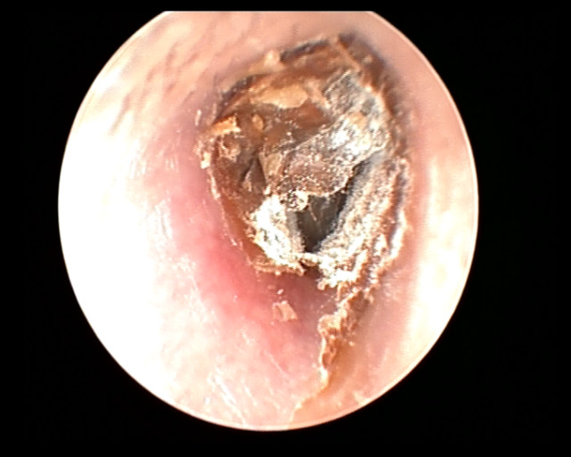 从37岁女子耳朵里取出来多根花花绿绿的毛医生表示很吃惊