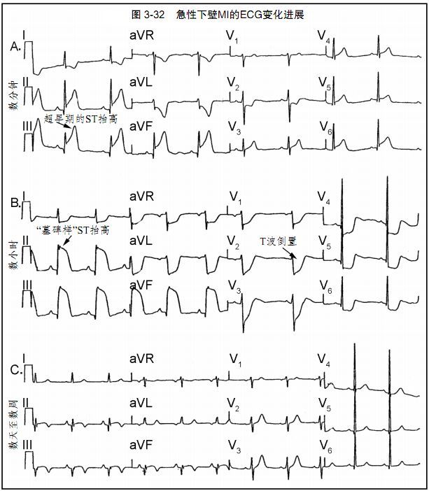 图文详解:心肌缺血和梗死的心电图