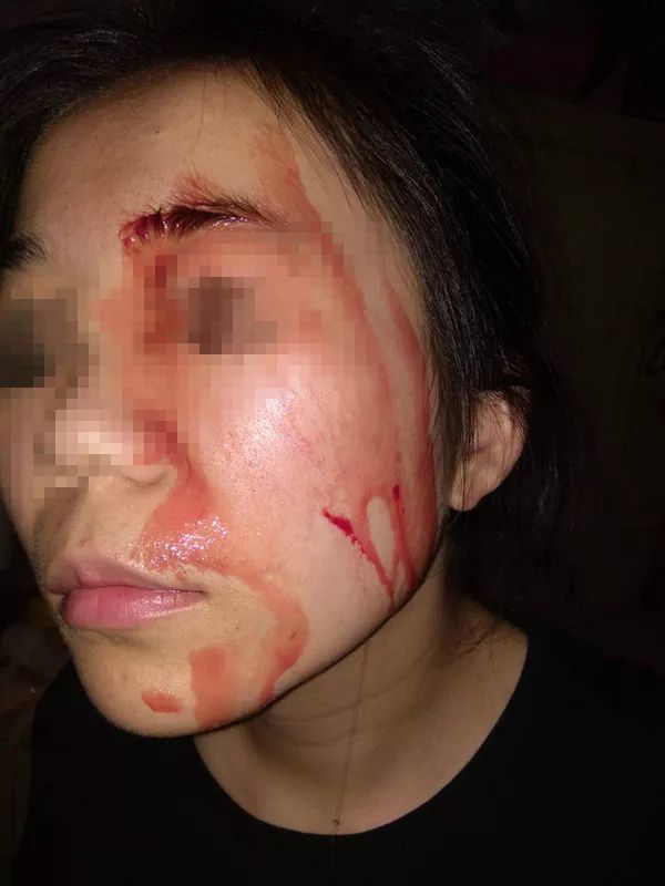 向全国医生求助!这女孩浑身汗毛孔都在往外渗