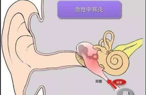 让孩子疼痛无比,甚至危害大脑,中耳炎这种换季