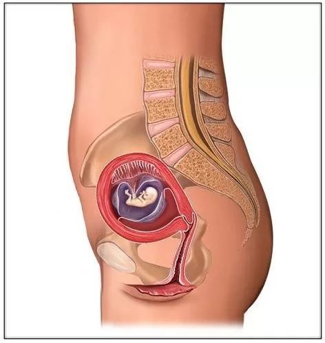 怀孕3个月(停经13周)时,在耻骨上2-3恒指处可摸到子宫底部;随着胎儿
