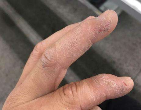 一味普通中药,能治严重手癣!是金子,迟早发光