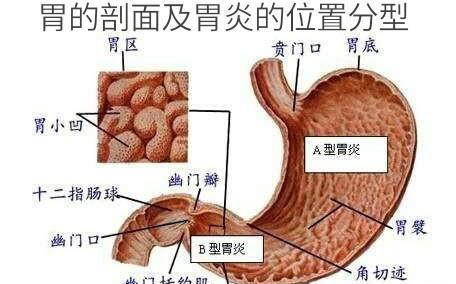 胃镜显示慢性非萎缩性胃炎伴糜烂,该怎么调养