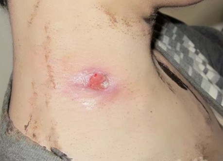 颈部淋巴结核能治好吗？不是癌症不要自己吓自己