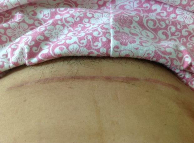 剖腹产后疤痕太明显,可能和体质有关,孕妈要引