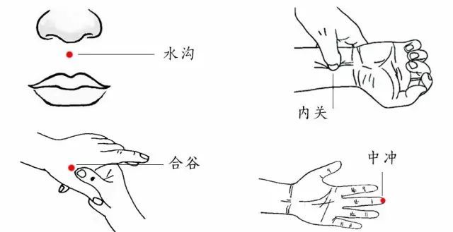 水沟刺法图片