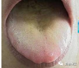 宝宝小舌头是身体健康的晴雨表要学会观察