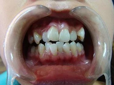 导致牙齿不齐的坑有很多你入的是哪个坑