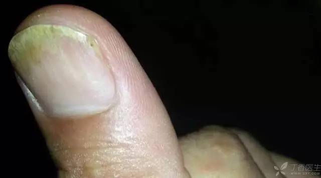 指甲上有竖条纹是怎么回事?我生病了吗?_腾讯新闻