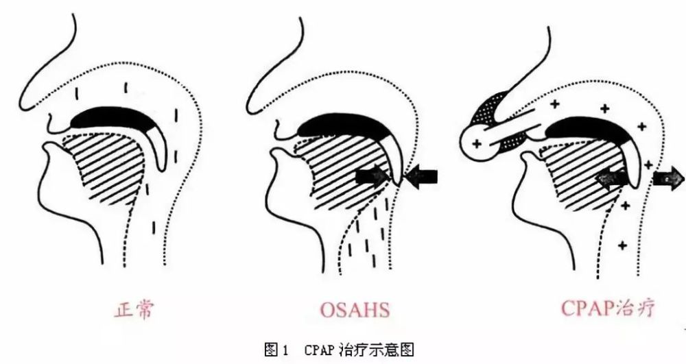 令人尴尬的打鼾问题该怎么解决