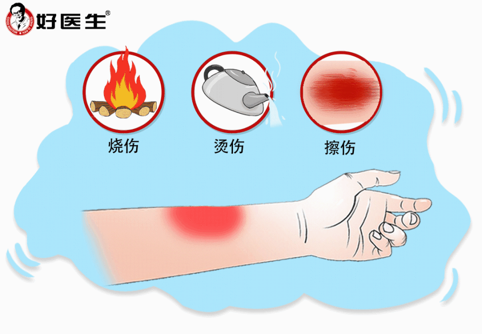 秦海璐烫伤后竟用大酱处理?这种做法不可取!