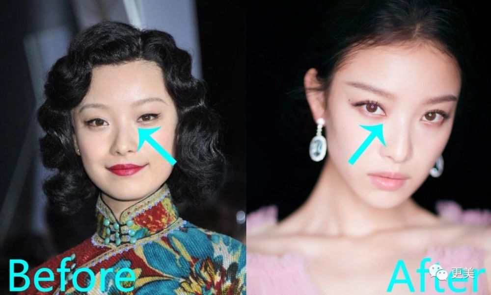 18线女星为有戏拍,把内眼角开到鼻梁上太拼了