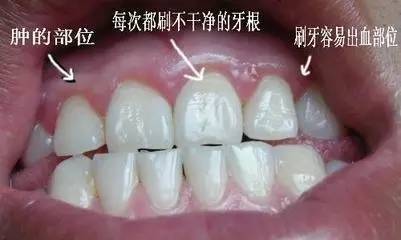 helen齿科中心——牙周炎的危害