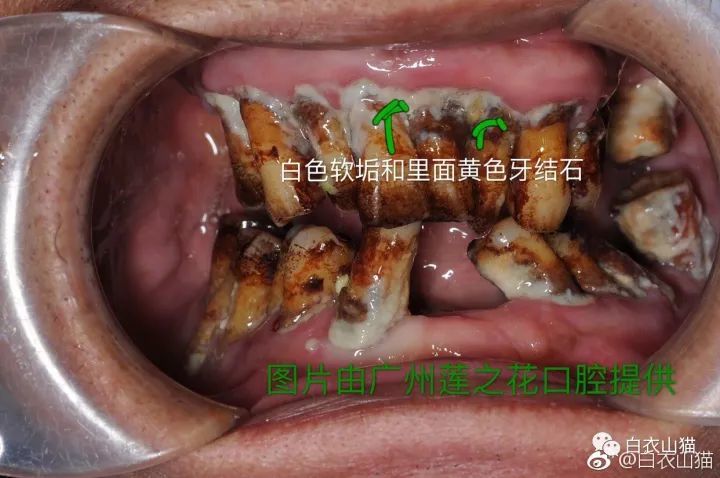 牙结石上图就是牙结石,图片由广州莲之花口腔提供.