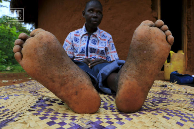 鹅眼恐怖的非洲沙蚤病