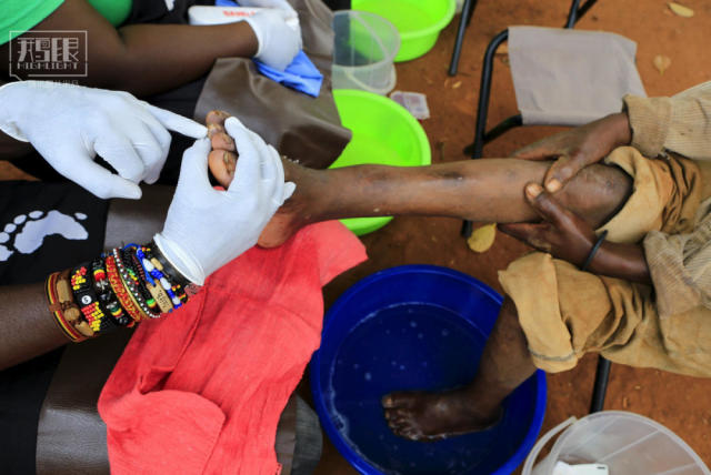 鹅眼恐怖的非洲沙蚤病