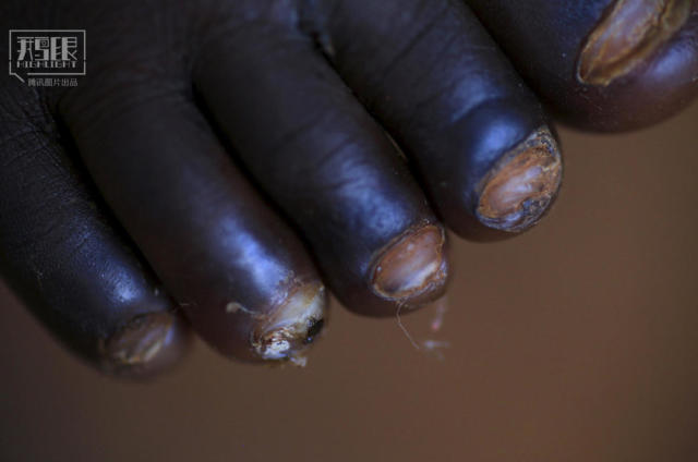 鹅眼恐怖的非洲沙蚤病